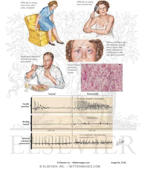 Polymyositis and Dermatomyositis