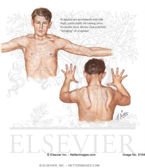 Watermarked preview of labeled image: Fascioscapulohumeral Muscular Dystrophy