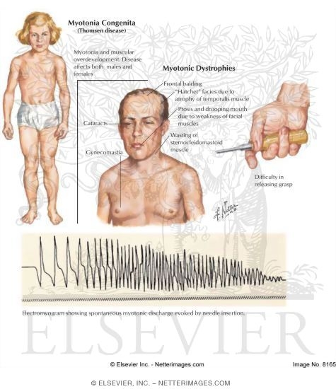 Myotonia Congenita and Myotonic Dystrophies