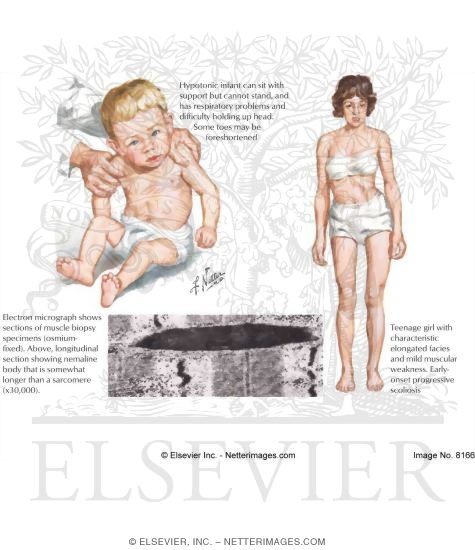 Watermarked preview of labeled image: Nemaline Myopathy