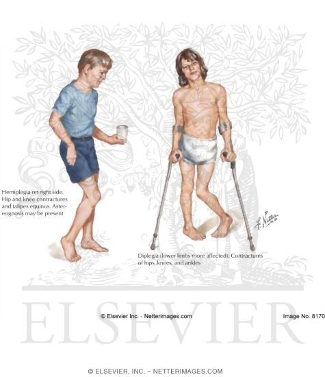 Cerebral Palsy