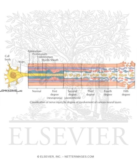 Sunderland Classification of Nerve Injury