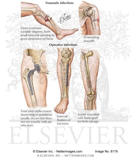 Watermarked preview of labeled image: Direct Causes of Osteomyelitis