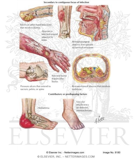 Watermarked preview of labeled image: Direct Causes of Osteomyelitis