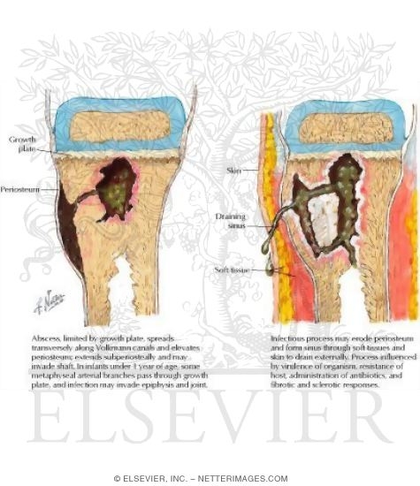 Spread of Hematogenous Osteomyelitis