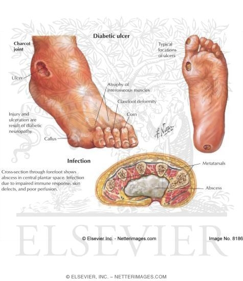 Lesions In Diabetic Foot