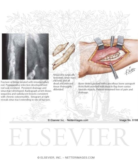 Chronic Osteomyelitis