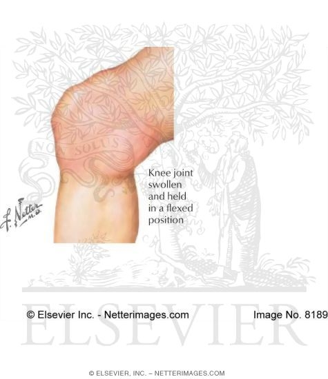 Watermarked preview of labeled image: Knee Joint Swollen and Held In a Flexed Position