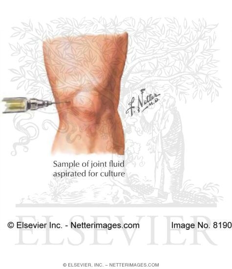 Watermarked preview of labeled image: Septic Joint Aspiration