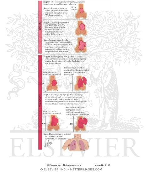 Watermarked preview of labeled image: Staging of Musculoskeletal Tumors