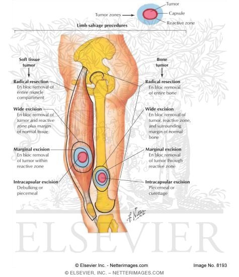 Watermarked preview of labeled image: Surgical Margins for Musculoskeletal Tumors