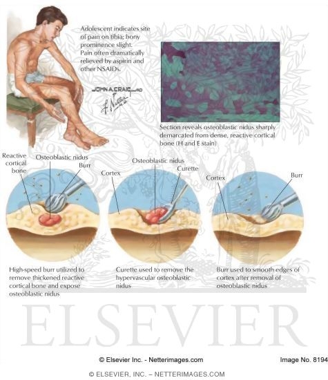 Watermarked preview of labeled image: Osteoid Osteoma