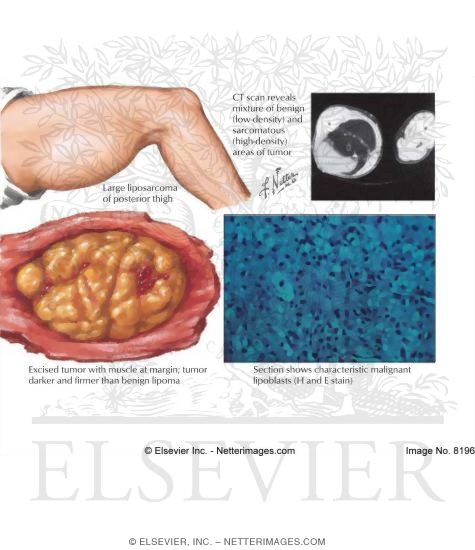 Liposarcoma