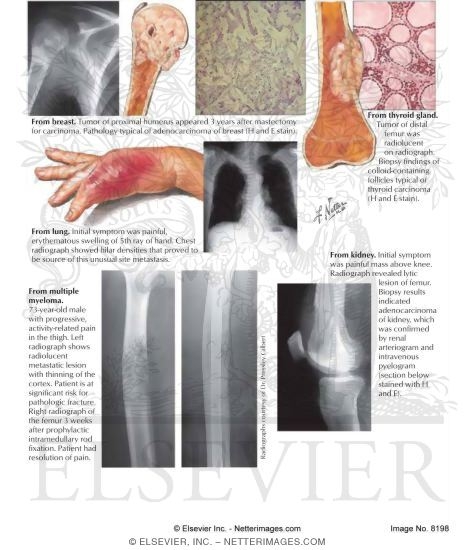Watermarked preview of labeled image: Tumors Metastatic to Bone