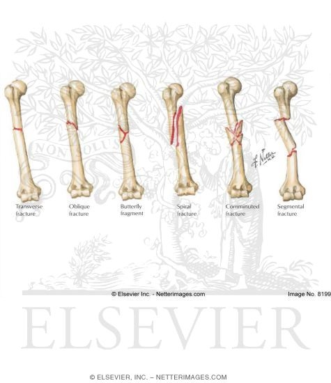 Fracture Patterns