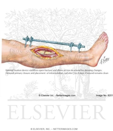 External Fixation of Open Fracture