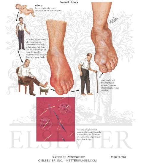 Clinical Aspects of Gout