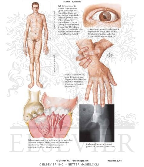 Marfan syndrome