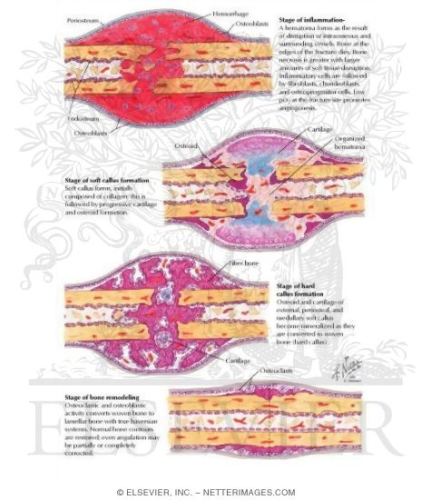 healing process of a bone fracture healing process of a bone fracture