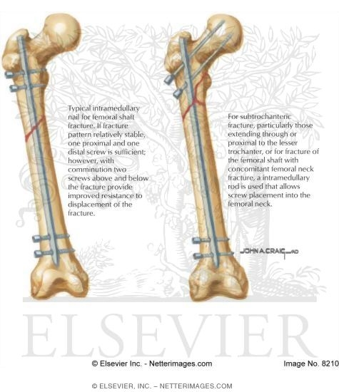 Tibia Intramedullary Nail Fixation | High Impact, LLC