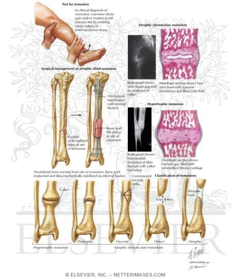 Nonunion of Fracture