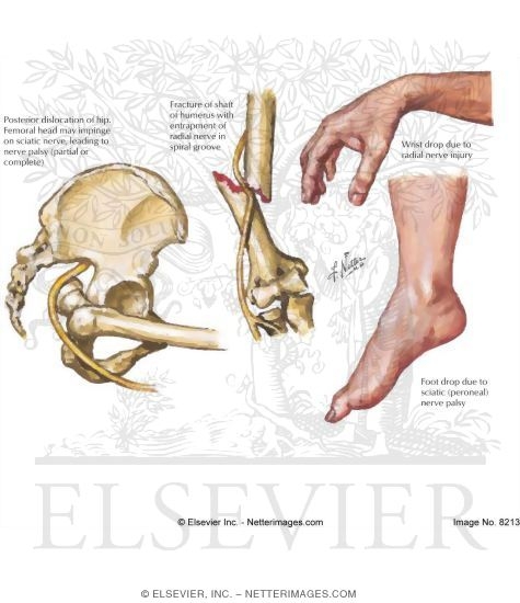 Watermarked preview of labeled image: Neurologic Complications of Fractures