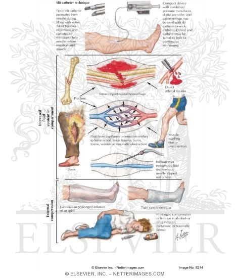 Watermarked preview of labeled image: Compartment Syndrome