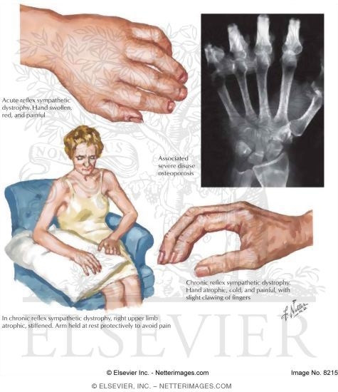 Watermarked preview of labeled image: Reflex Sympathetic Dystrophy