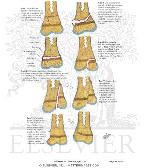 Peterson Classification of Physeal Fractures