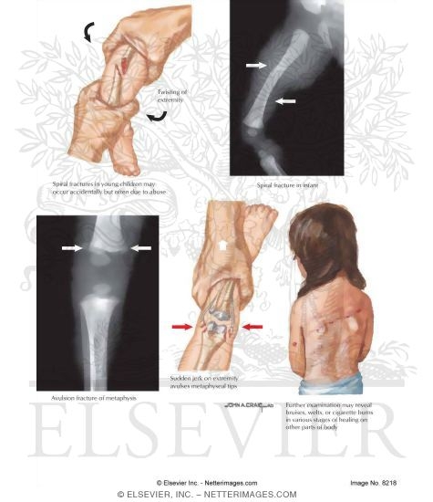 Watermarked preview of labeled image: Fracture In Abused Children