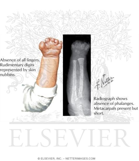 Congenital Transmetacarpal Amputation