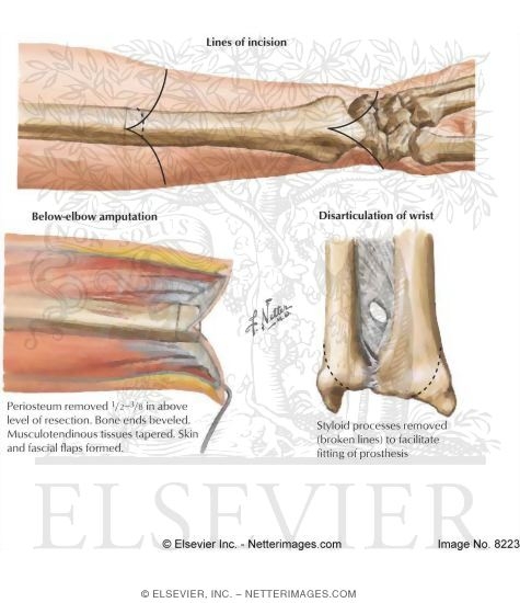 Forearm Amputation