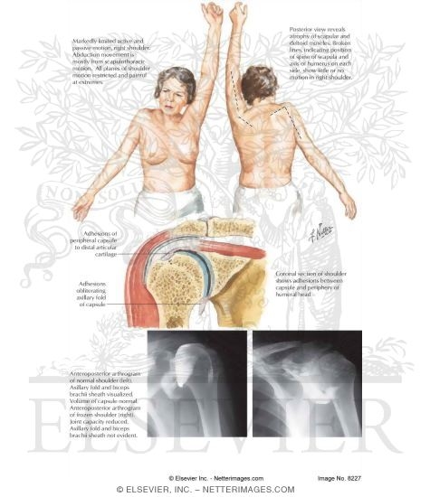 Watermarked preview of labeled image: Adhesive Capsulitis of Shoulder (Frozen Shoulder)