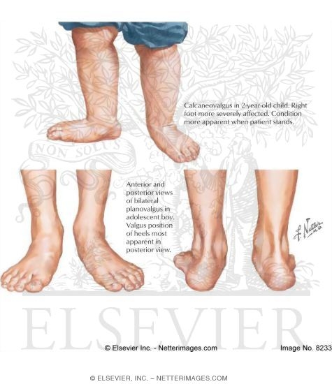 Planovalgus foot deals