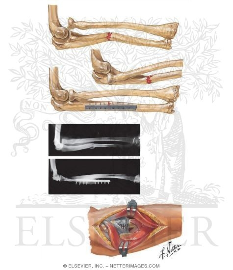 Watermarked preview of unlabeled image: Fracture of Shaft of Ulna