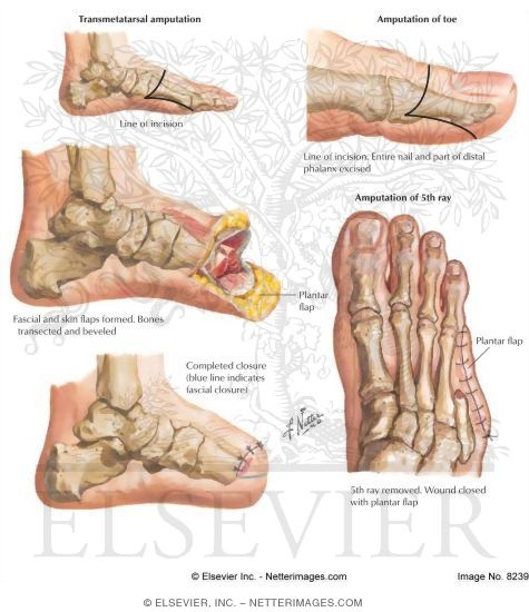 Amputations of the Foot