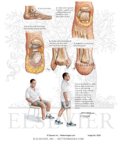 Ankle Disarticulation (Syme Amputation)