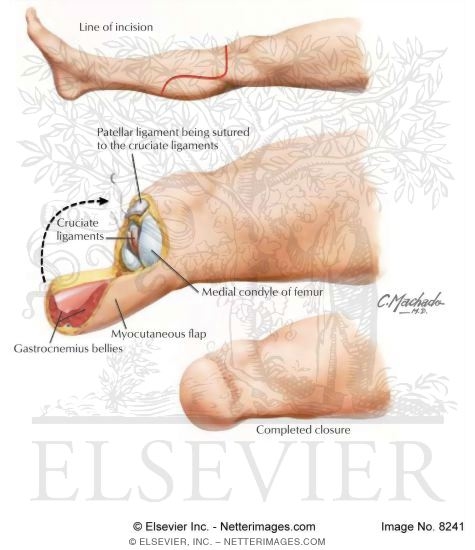Transtibial Amputation