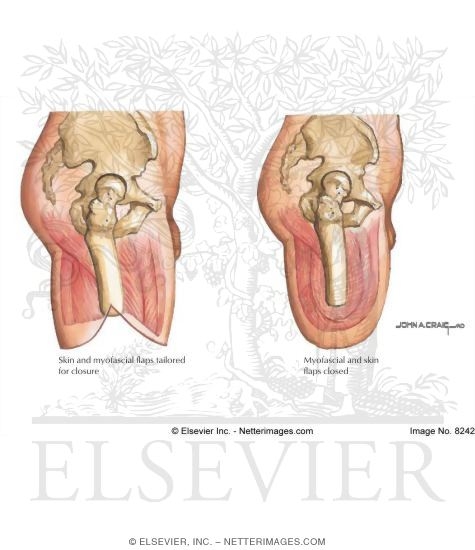Transfemoral Amputation