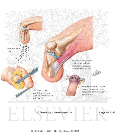 transtibial amputation