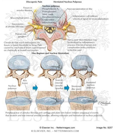 Watermarked preview of labeled image: Lumbar Disk Herniation