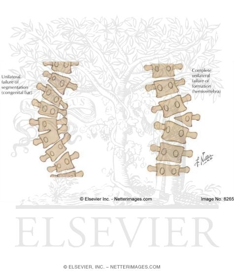 Watermarked preview of labeled image: Congenital Scoliosis