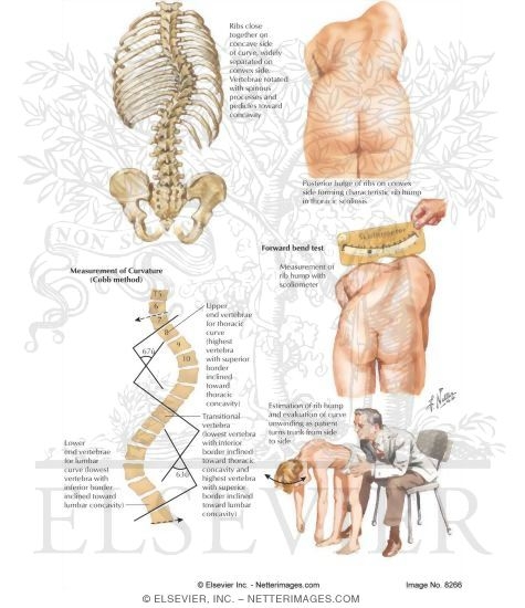 Watermarked preview of labeled image: Scoliosis