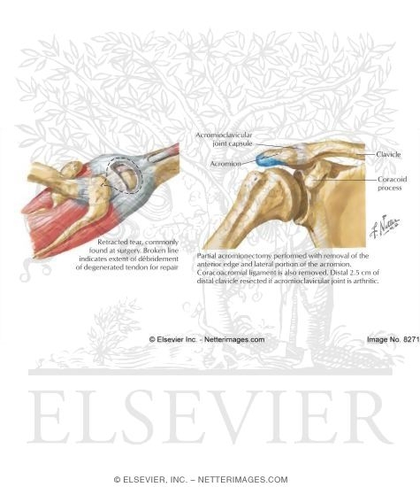 Watermarked preview of labeled image: Acromioplasty