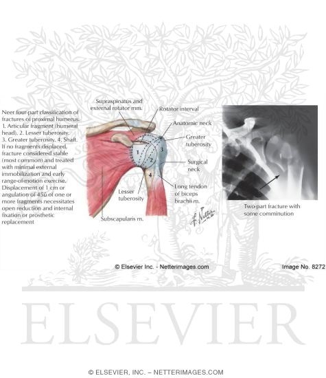 Watermarked preview of labeled image: Fracture of Proximal Humerus