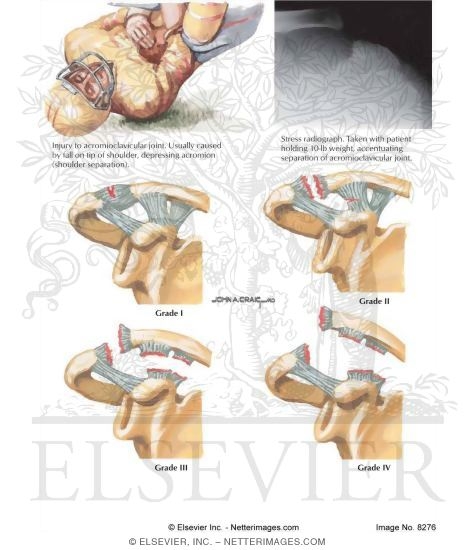 Watermarked preview of labeled image: Acromioclavicular Dislocation