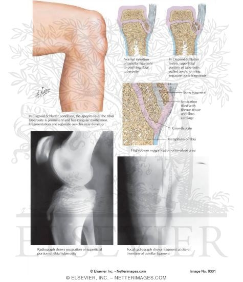 Watermarked preview of labeled image: Osgood-Schlatter Lesion