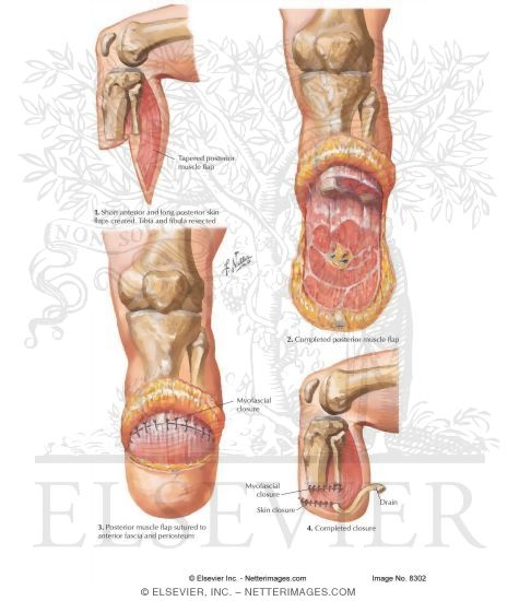 transtibial amputation