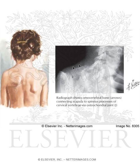 Sprengel Deformity