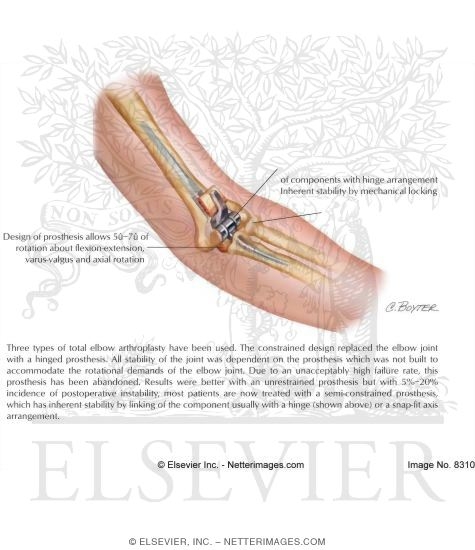 Watermarked preview of labeled image: Prosthesis for Total Elbow Arthroplasty